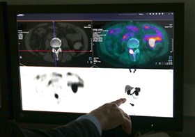 Esame PET con 68-Gallio PSMA